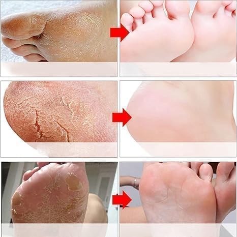 Goat Milk Foot Peel Mask (6 Pack), Exfoliating Foot Mask for Dry Cracked Feet, Dead Skin Callus Remover, Foot Exfoliator for Baby Soft Feet (Goat Milk)