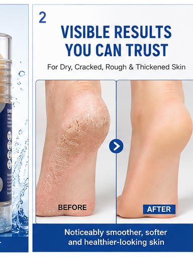 EVANIA 60% Urea Foot Care Stick with 2% Salicylic Acid – Cracked Heel Treatment, Callus Remover & Foot Moisturizer for Dry Feet, Rough Skin, Knees, Elbows & Hands – Intensive Repair Balm 1.41oz