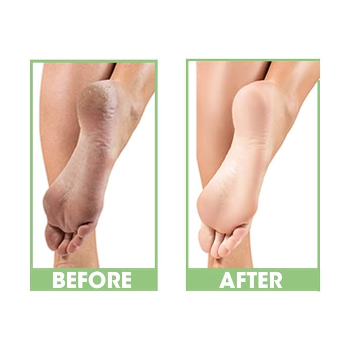 ProLinc Dry Heel Eliminator | Protect and Hydrate Dry Heels and Feet | Fast Absorbing and Non Greasy | Made in the Usa | 4 Fl. Oz