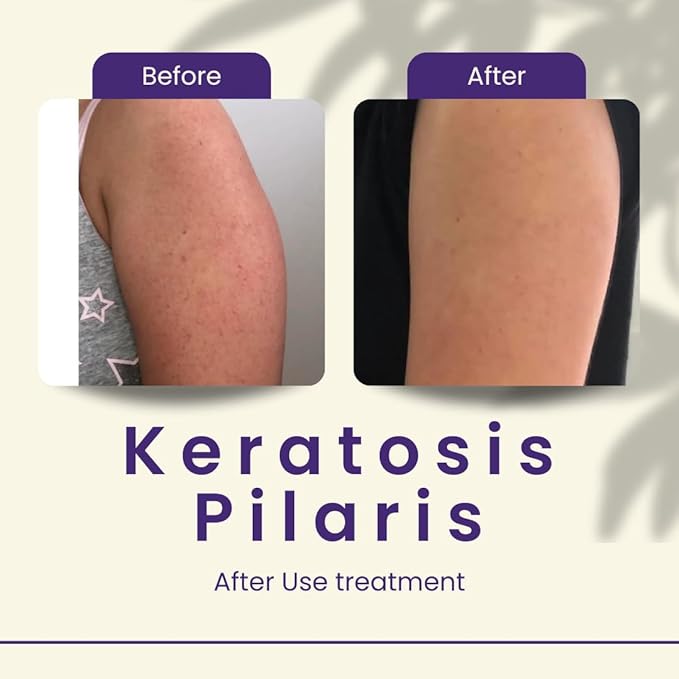 Areton KP Bump Eraser Cream – Exfoliating Treatment for Keratosis Pilaris & Rough Skin with 8 Active Ingredients