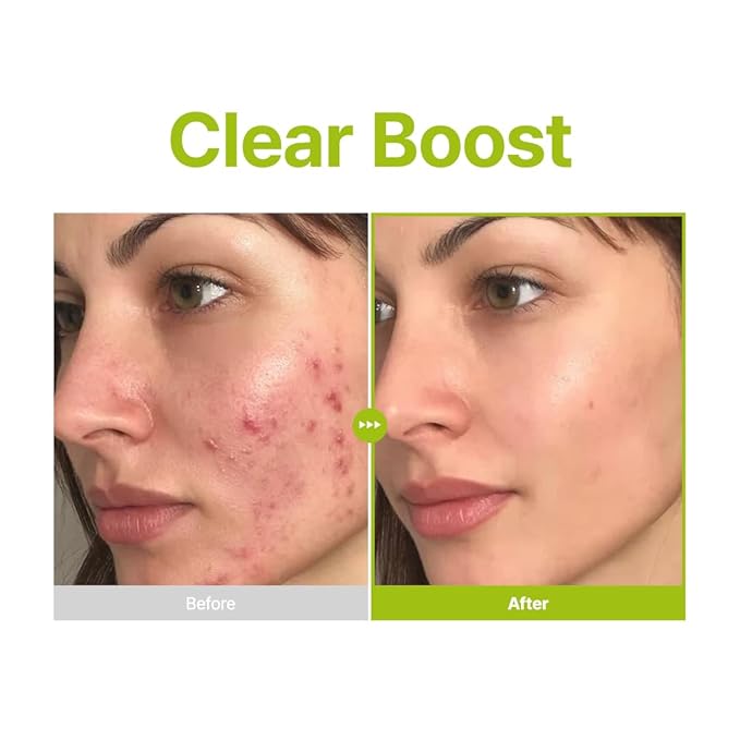 PURITO Azelaic Acid 10% + Kojic Acid + Tea Tree Facial Serum | for Blemish-Prone, Oily & Sensitive Skin | Redness Soothing | Korean Skincare, 30mL 1.01 fl.oz