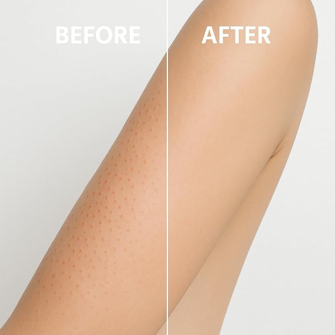 Microdermabrasion Keratosis Pilaris & Acne Exfoliating Deep Cleansing Face & Body Scrub, KP Bump Eraser, Back Acne Exfoliant, Wash Cleanser - Rough, Bumpy & Dry Skin Gets Rid Of Redness
