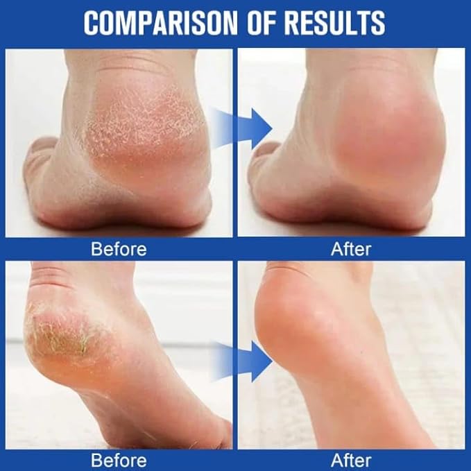 60% Urea Cream Stick with 2% Salicylic Acid, Maximum Strength Callus Remover for Dry Cracked Heels, Hands, Knees, Exfoliating Moisturizer, 1.41 oz (1pcs)