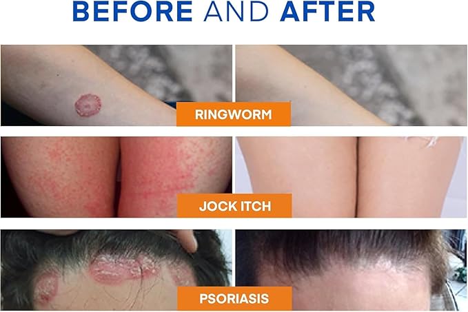 Antifungal Ringworm Treatment Body Wash - Antibacterial Wash with 1% Tolnaftate & Tea Tree Oil for Ringworm, Jock Itch, Tinea, Back Acne & Foot Odor on back, chest, groin, feet for Men and Women 500ml