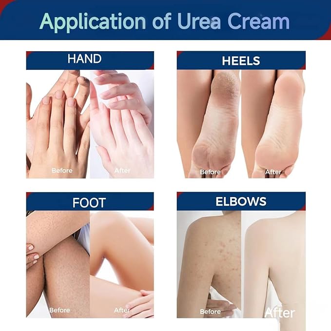 OUKEYA 2 Pack Urea Cream 42 Percent with 2% Salicylic Acid Tube 3 Oz