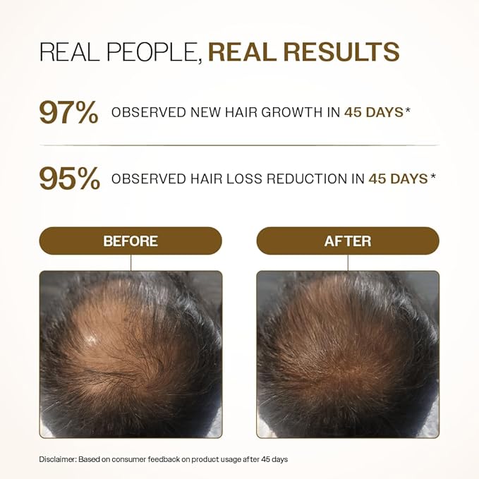 Bare Anatomy Advanced Hair Density Roll-On| 3% Redensyl + 4% Anagain + 2% Baicapil + 5% Rosemary, Rice Water, Biotin & Saw Palmetto| Reduces Hair Fall, Supports Hair Growth for Men & Women | 25ml