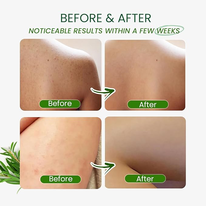 PHARMBANNER Tea Tree Antifungal Body Wash – Soothes Folliculitis, Acne, Jock Itch, Athlete’s Foot, Ringworm, Tinea Versicolor, Body Odor, Eczema & Dermatitis-Prone Skin
