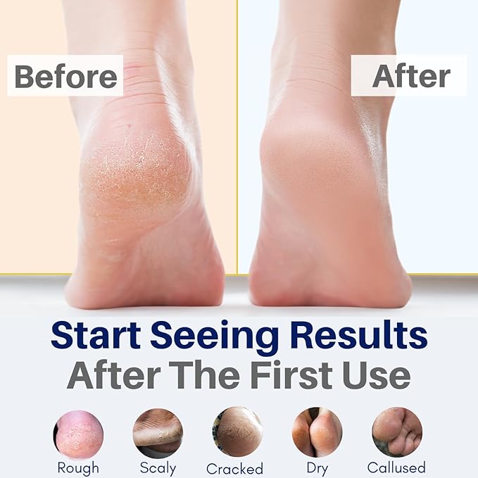 All Natural Foot Cream for Cracked Heels & Dry Feet – USA Made Organic Foot Balm for Callus Softening – Hydrating Foot Care Moisturizer with Peppermint, Tea Tree, Lavender & Eucalyptus