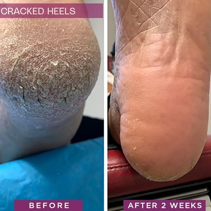 Rapid Crack Repair Cream, 25% Urea with Lactic Acid, Restores Cracked Heels and Diabetic Feet, Post-Surgery Scar Care, Fragrance-Free Barrier Cream, 3 oz