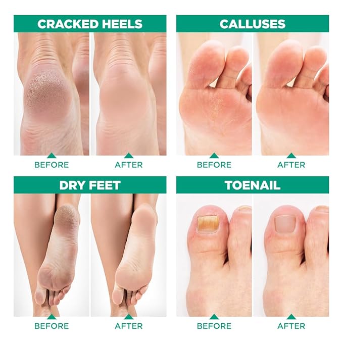 Tea Tree Oil Foot Soak with Epsom Salt - Made in USA - for Toenail Health, Athletes Foot, Stubborn Foot Odor, Softens Calluses & Soothes Sore Tired Feet - 1 LB