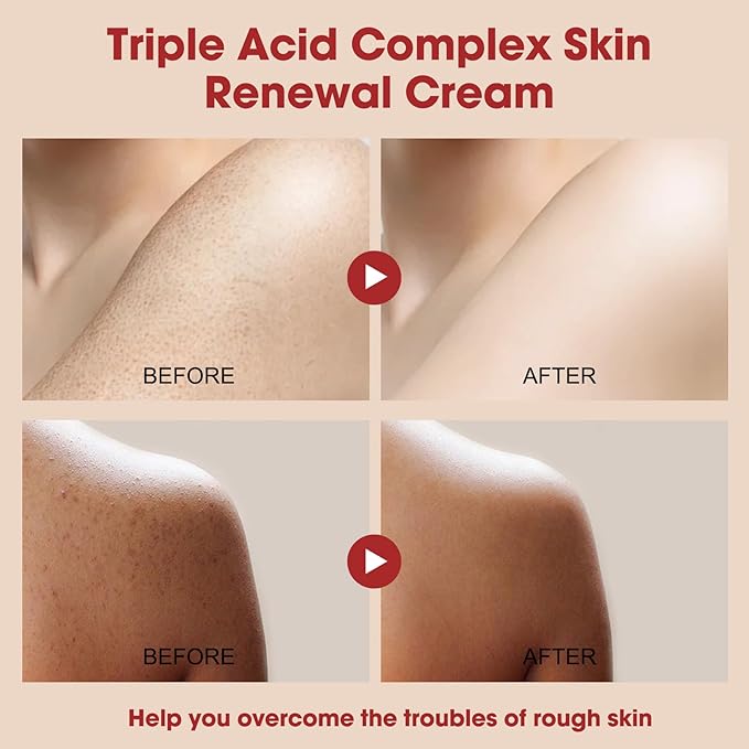 Skin Treatment Resurfacing Cream for Keratosis Pilaris, Advanced Triple-Acid AHA BHA PHA Exfoliator Lotion — Smooths Chicken Skin Bumps, Hydrating, Brightening & Soothing