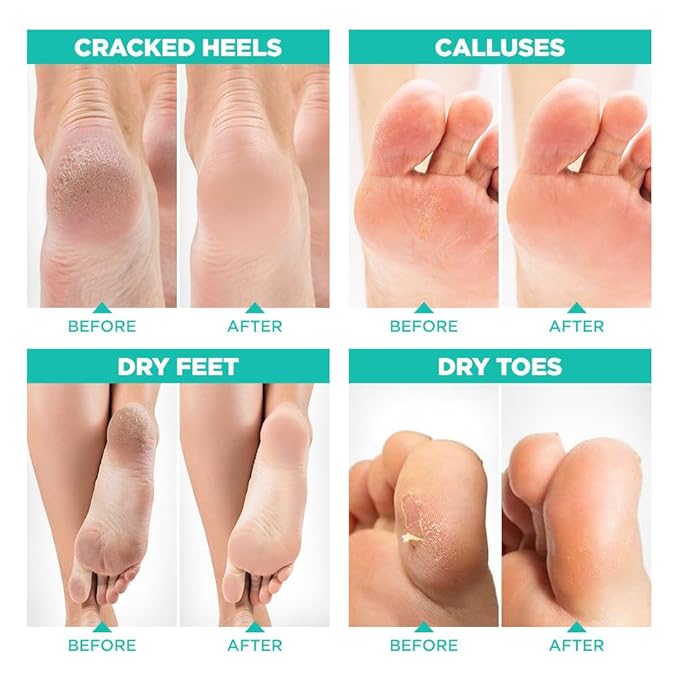 Peeling Foot Mask that Remove Dead Skin and 40% Urea Cream with Maximum Strength Moisturizing