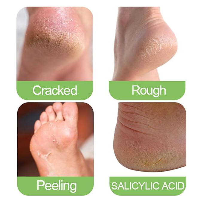 Grospe Urea Cream 60% For Feet Maximum Strength, 60% Urea Cream with 2% Salicylic Acid for Feet & Hands Moisturizer for Rough, Dry, Thick & Cracked Skin, Callus Remover, Deep Hydration 1.76 oz