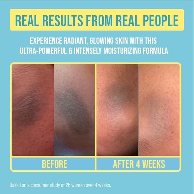 Red by Kiss Glow Up Brightening Body Cream, Kojic Acid, Turmeric & Glutathione for Dark Spots, Hyperpigmentation, Body Acne Scars & Uneven Skin Tone, 16.23 fl oz