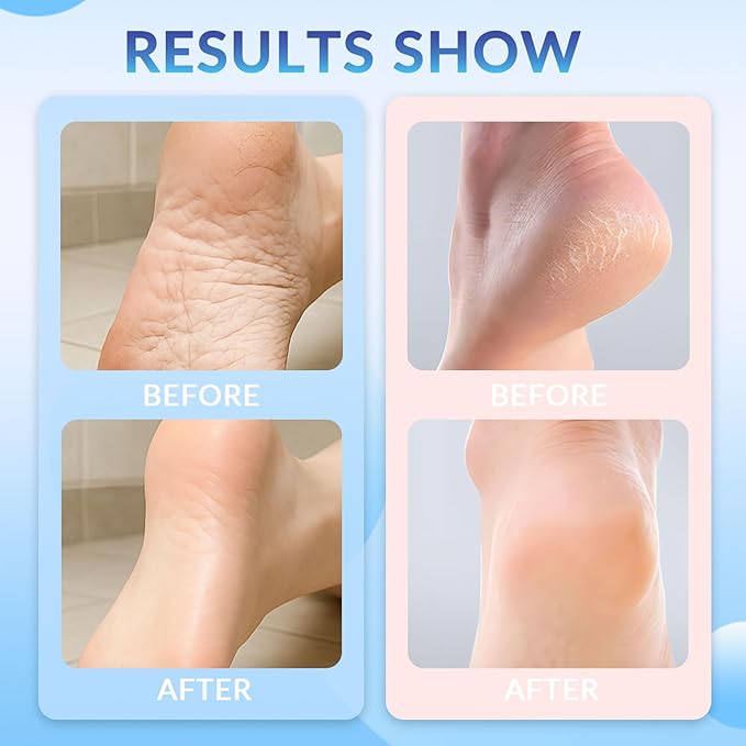 Crack Feet Prevention Stick, Anti Cracked Foot Cream For Dry Heels, Moisturizing Foot Balm Stick, Remove Dead Skin And Softening Dry Skin (Pink+Blue)