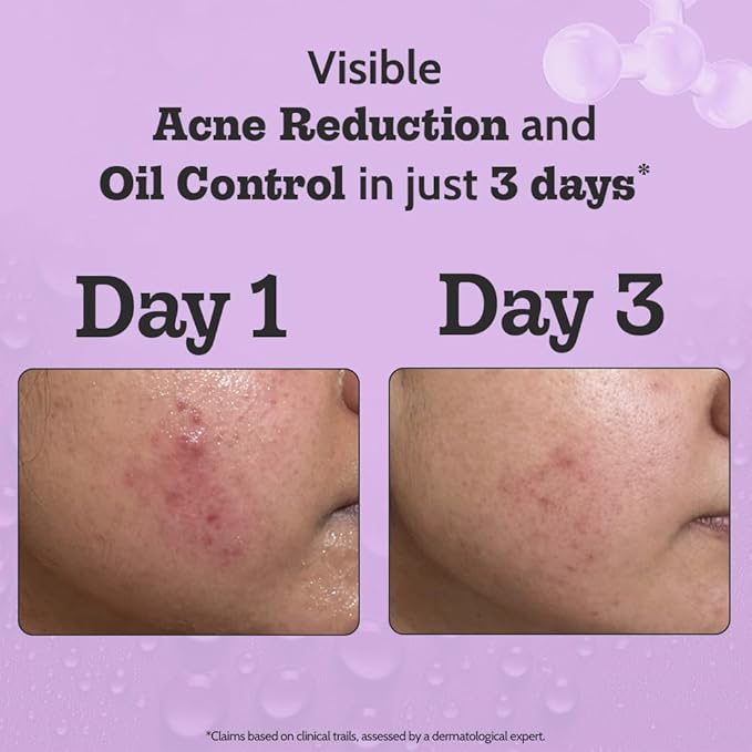Chemist At Play 2% Salicylic Acid Face Serum | Treats Active Acne | Controls Excess Oil | Fades Acne Marks | Improves Skin Texture | 30ml