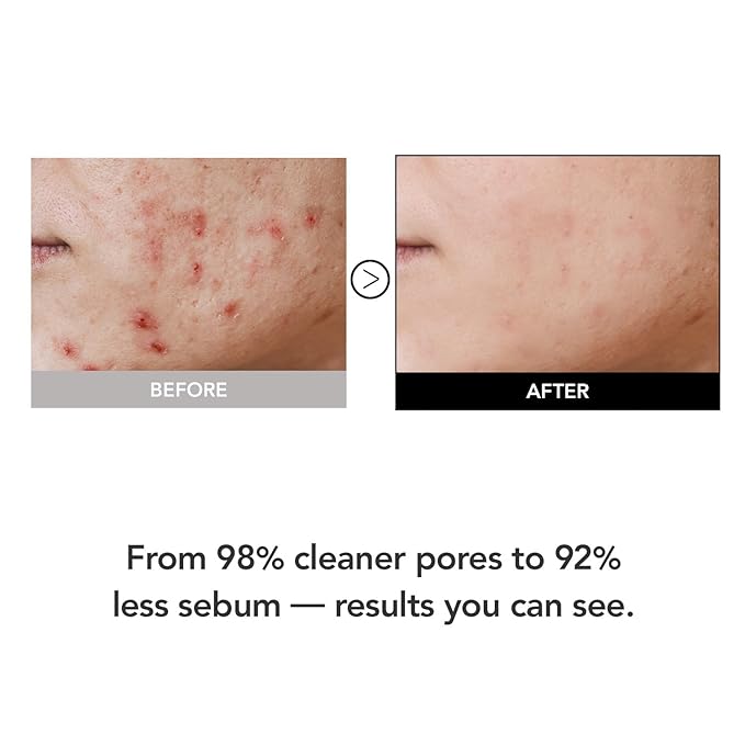 15.5% Panthenol & Cica Exosome | Removes 98% of Pore Impurities | AHA BHA PHA Gentle Exfoliating Wash | Non-Comedogenic | Korean Skincare Cleansing Foam (120ml/4.06 fl.oz.)