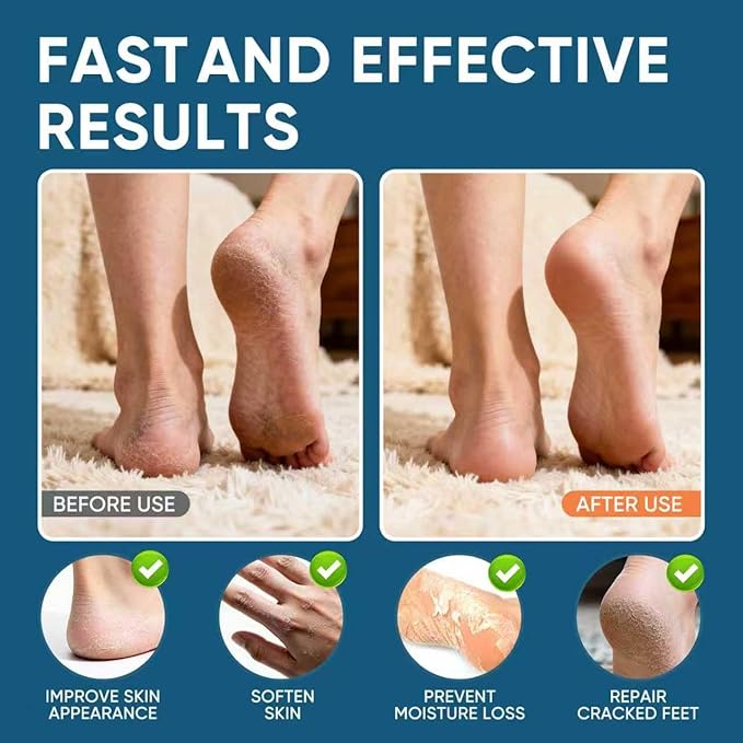 Urea Cream 60% with 2% Salicylic Acid, Urea Cream 60 Percent for Feet Maximum Strength, Foot Cream & Callus Remover for Dry Cracked Heels, Rough Thick Skin, Deep Hydration, 5.29 oz