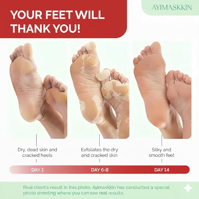 Peeling Foot Mask 5 Pack | Lavender Extract Foot Peel for Dead Skin Removal & Heel Repair | Dermatologically Tested