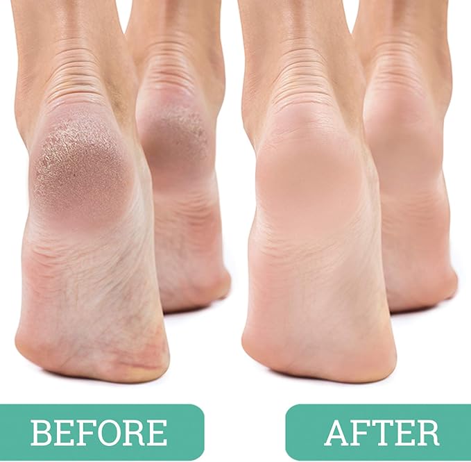 Salon Foot Pumice and Scrubber for Feet and Heels Callus and Dead Skins, Safely and Easily Eliminate Callus and Rough Heels (Pack of 3)