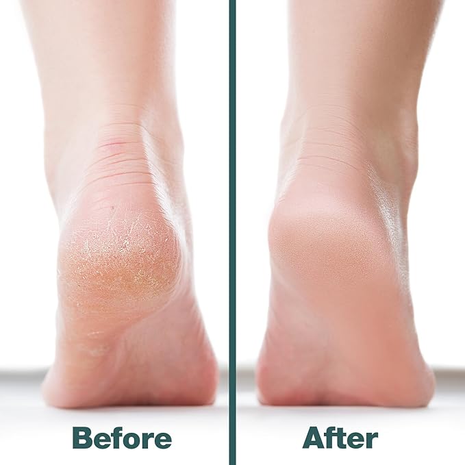 Probelle Double Sided Multidirectional Nickel Foot File Callus Remover - Immediately Reduces calluses and Corns to Powder for Instant Results, Safe Tool (Dark Grey)