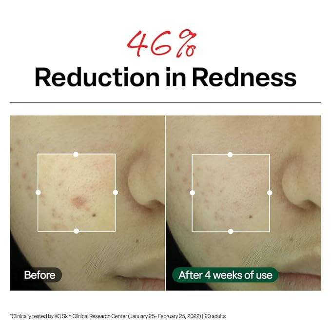 Dr. G R.E.D. Blemish Clear Soothing Cream - Calming Korean Moisturizer for Redness - Soothes Acne & Irritation - With Centella Asiatica - Long-Lasting Hydration - 2.36 fl oz