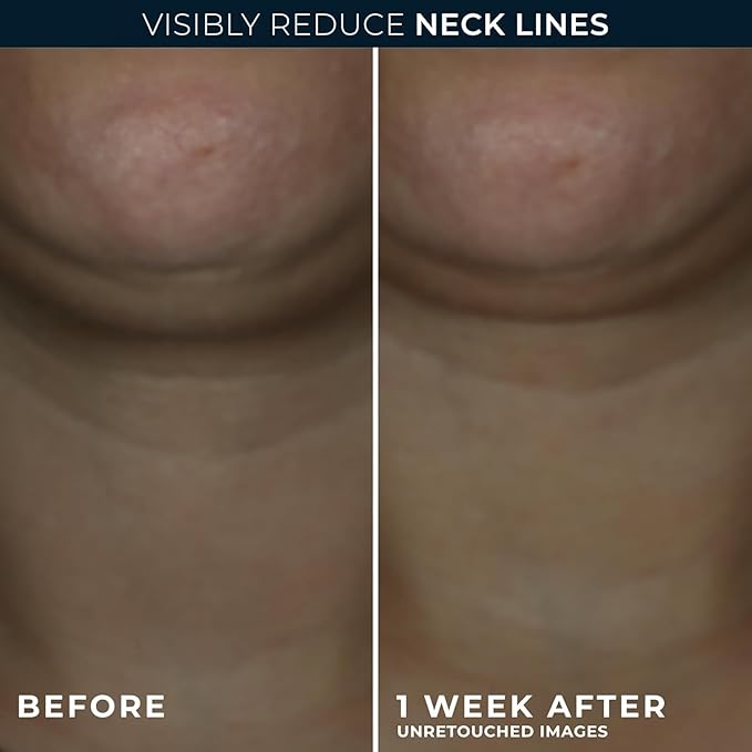 RoC Derm Correxion Neck Cream with Hyaluronic Acid + Advanced Retinol to visibly Tighten & Lift Horizontal Neck Lines, Facial Moisturizer to Contour Face (1.7 oz) with RoC Retinol Eye Packette