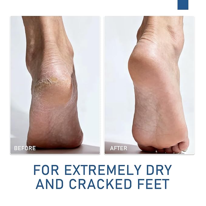 2Pcs Urea Cream 60% plus 2% Salicylic Acid Urea Foot Cream Stick,Foot Cream for Dry Cracked Heels and Feet,Hands,Elbows,Knees,Exfoliating Moisturizer,Soften Dead Skin Foot Balm,1.41 Oz