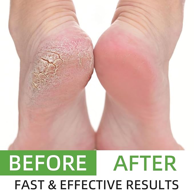 Urea Cream 60 Percent for Feet Maximum Strength, Cracked Heel Stick, Urea Foot Cream for Very Dry Feet Knees Elbows Hands, Thickened Skin, 40g/1.41oz