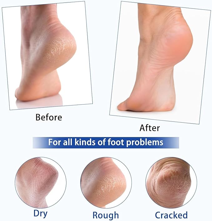 Urea Cream,40% Foot Care lotion for chapped heels, chapped heels, super, rough, dry, calloused feet, soften rough skin on feet 5.29 fl.oz for all skin