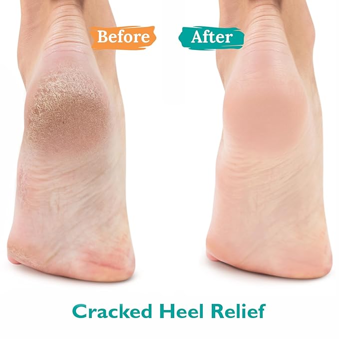 GILDEN TREE Urea Gel 42 Percent For Feet Maximum Strength Softens Cracked Heel Calluses & Thick Toenails