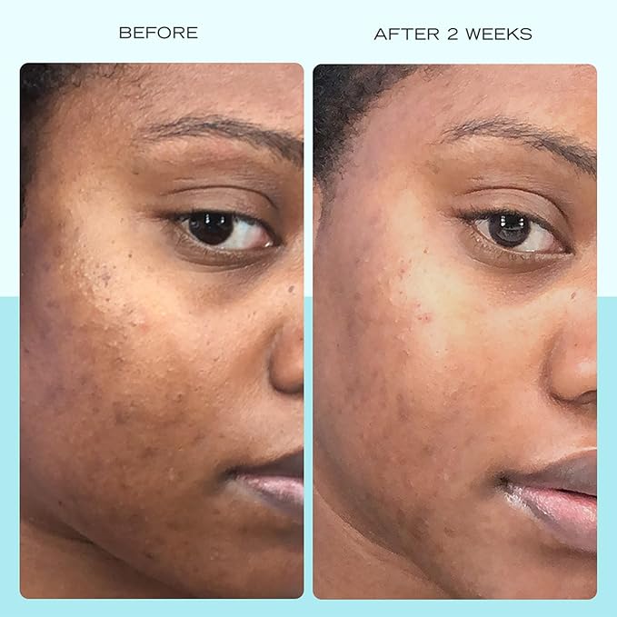 First Aid Beauty - Dark Spot Serum with Niacinamide, Helps Reduce Look of Dark Spots, Sun Spots, Hyperpigmentation, Discoloration & Post-acne marks, Non-Comedogenic, Safe for Sensitive Skin, 1 oz