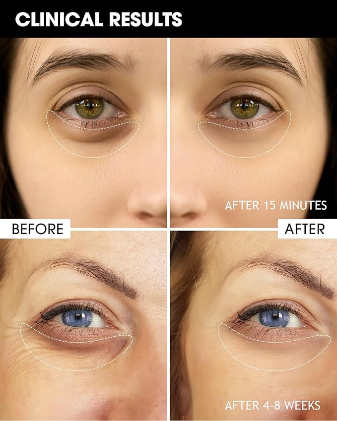 Eye Cream with 6% High-purity Caffeine & 1% Bakuchiol, Under Eye Cream for Dark Circles, Puffiness, Fine Lines, Anti Aging, Wrinkles, Eye Bags Treatment for Women & Men with 360° Roller, 0.57oz