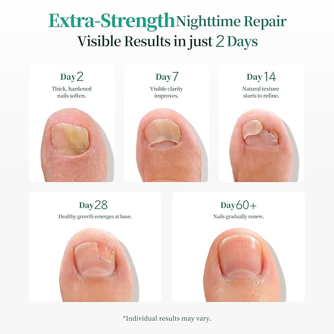 APUREE Fungal Nail Patches Extra Strength: True 1% Tolnaftate| FSA-HSA |8H Overnight Toe Nail Fungal Treatments | Repair For Discolored Yellow Brittle Damage Nails|Renews Healthy Appearance|32 Patch