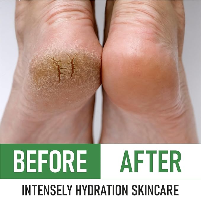 PurOrganica Urea 40% Foot Cream – Dermatologist Tested, Intensive Repair for Dry, Cracked Heels, Corns, Calluses & Rough Feet, Professional Strength Exfoliating & Moisturizing Cream - Made in USA