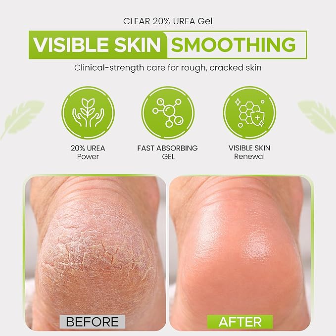 CLEAR 20, 20% Urea Gel, 4 oz w/ Tea Tree & Coconut Oil, Aloe Vera Extract, Callus & Corn Remover Moisturizes & Softens Cracked Heels, Feet, Elbows, Hands, Nails, Superior hydration to Urea Creams