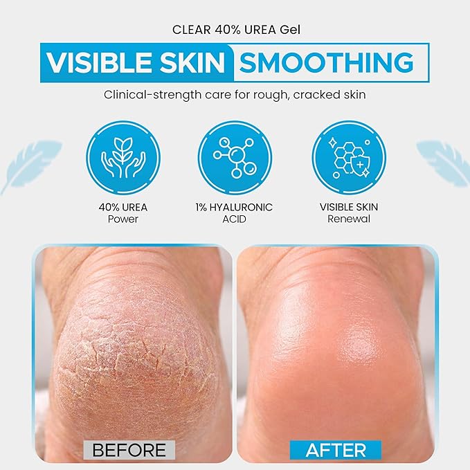 Urea 40% + 1% Hyaluronic Acid (4oz) | Softens Cracked Heels & Dry Skin Urea Cream 40 Percent for Feet Maximum Strength - Infused w/ Tea Tree & Coconut Oil | Callus & Corn Treatment | Made in USA