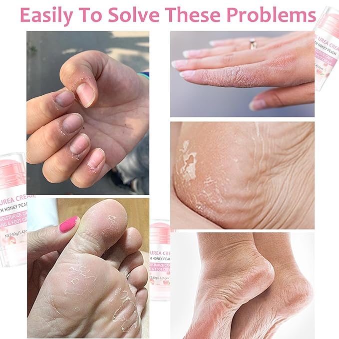 10% Foot Urea Cream for Feet Hand Care - 2Pcs Heel Stick for Cracked Feet Dry Rough Heels, Hands, Elbow and Knees - Moisturizing Urea Foot Stick Balm Intensive Moisturizer for Dead Skin , 1.41oz