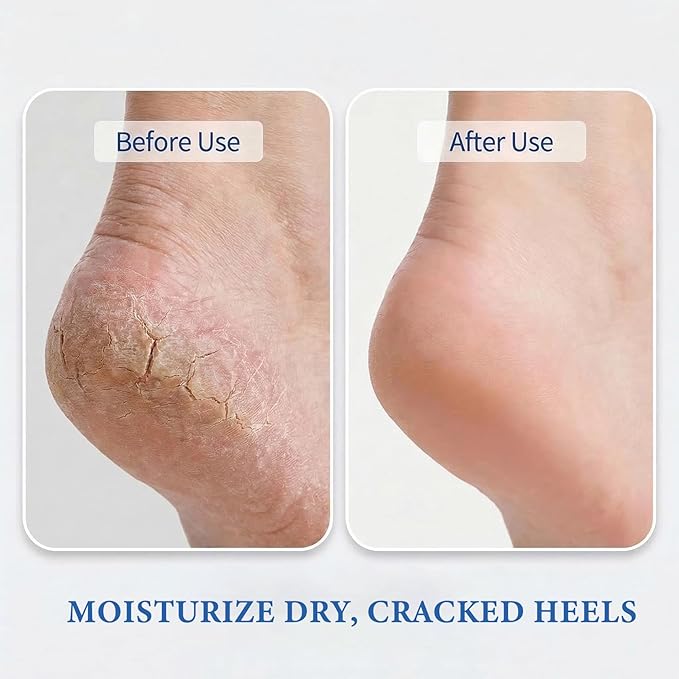 2Pack 60% Urea + 2% Salicylic Acid Foot Care Stick,Maximum Strength Urea Foot Cream,Deeply Moisturizes Cracked Heels,Dry Hands & Rough Knees,Exfoliates & Softens Skin Urea Foot Stick
