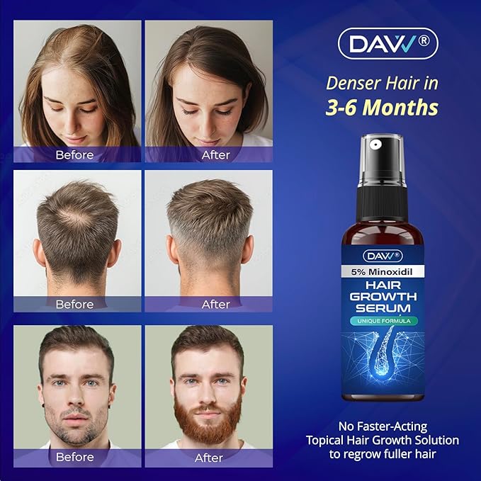 5% Minoxidil for Women and Men: 3-Pack Minoxidil Hair Growth Serum for Men Women with Biotin - Hair Regrowth Treatment - Extra Strength - Hair Growth Products - Minoxidil for Men - Hair Loss Solution