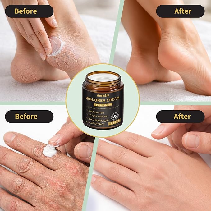 Urea Cream 40% Plus Salicylic Acid 2%, Foot Cream for Dry, Cracked Heels, Calluses Professional Feet Maximum Strength Moisturizing Cream, 155g