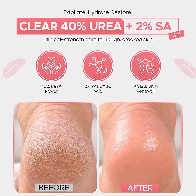 CLEAR Urea Cream 40 Percent Plus 2% Salicylic Acid (4oz) Made in USA | Urea Foot & Hand Cream Softens Cracked Heels & Dry Skin with Tea Tree & Coconut Oil - Callus & Corn Treatment