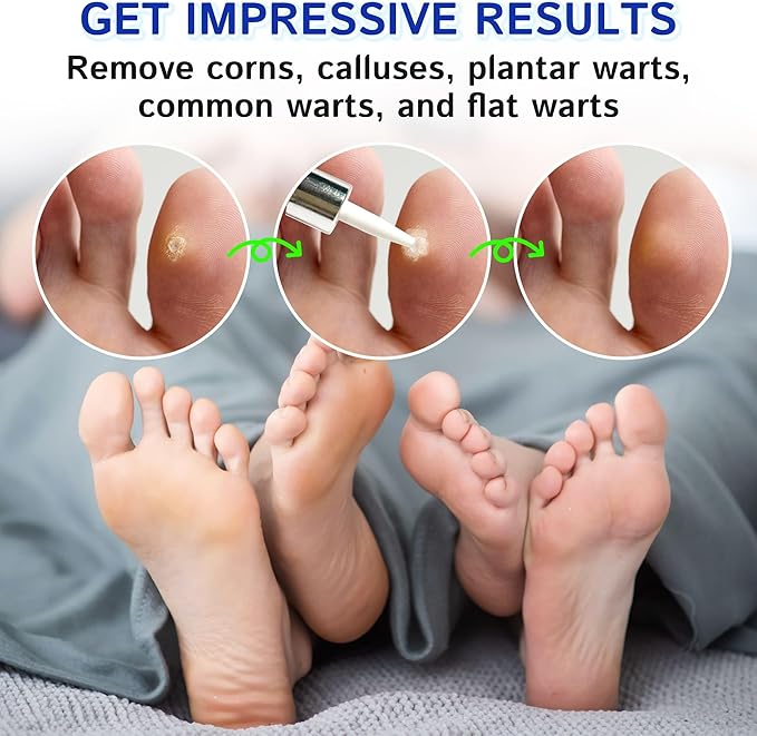 Ulensy Corn Remover Liquid for Toes Feet: 20ml Salicylic Acid for Foot Corns Calluses Wart Removal at Work Home - Safe for Kids Teens Adults Seniors Athletes Runners Workers Men Women