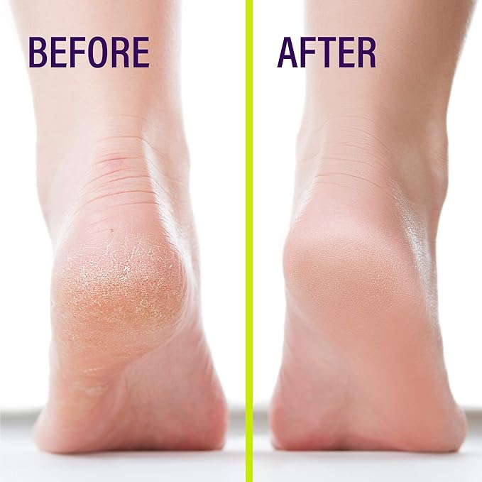 Liquid Skin Protectant for Cracked Heels, Feet Treatment, Liquid Bandage, Foot Care for Cracked Feet, Calluses, Blisters, Foot Repair, Applicator and Buffer, 1Pk