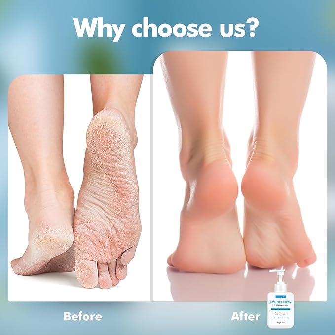 Urea Cream 40 Percent for Feet Maximum Strength, Urea Foot Cream Plus 2% Salicylic Acid, Tea Tree Oil, Coconut Oil and Aloe Essence for Feet Dry Cracked Heels Hands Elbows Knees