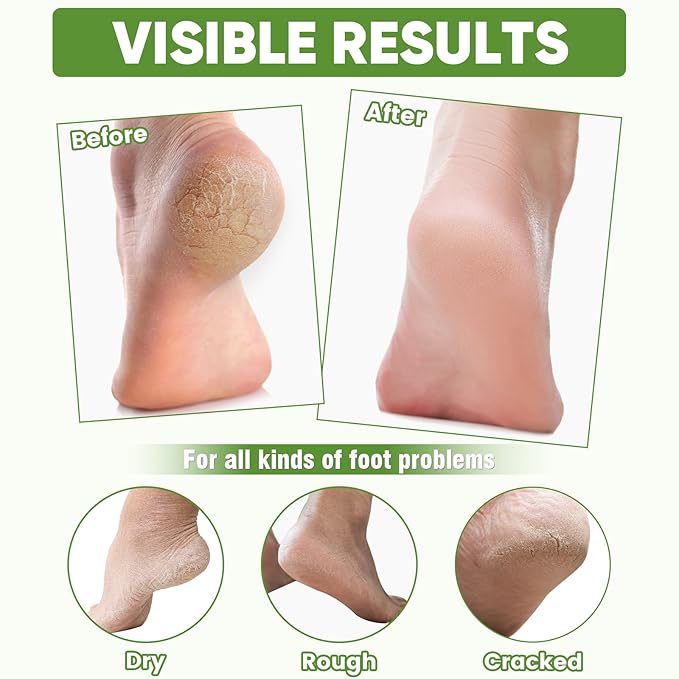 TEAWOO 16 Pairs Moisturizing Foot Masks with Aloe Vera Extract & Jojoba Oil, Intensely Hydrating Foot Mask for Dry Cracked Feet, Moisturizing Socks for Cracked Heel Treatment