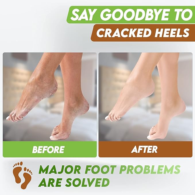 karma organic Feet Peeling Masks for Dry Cracked Feet, Remove Dead Skin & Calluses - Removes & Repairs Rough Heels, Dry Toe Skin (Pack of 2)