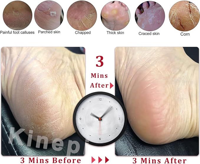Kinepi Callus Remover Foot Scrubber Colossal Foot File Foot Care and Foot Exfoliator Foot Rasp Pedicure Tools Pumice Stone for Feet,Remove Corn Hard Skin Dead Skin for Use in Shower Foot Scraper Kit
