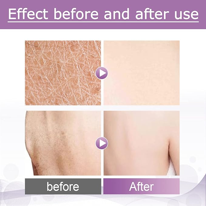 Bump Eraser Body Scrub Exfoliant for Keratosis Pilaris Body Acne Dead Skin Ingrown Hair Razor Bumps and Rough Patches Keratosis Pilaris Treatment Strawberry Legs Treatment for Women