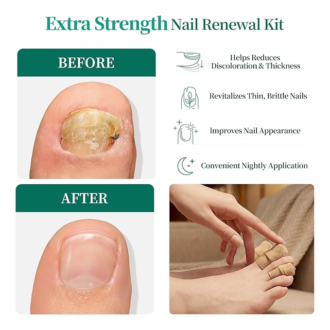 APUREE Fungal Nail Patches Extra Strength: FSA-HSA True 1% Tolnaftate | 8H Overnight Toenail Treatment |Repair For Discolored Yellow Brittle Damage Nails| Restores Healthy Appearance| 64 Patch